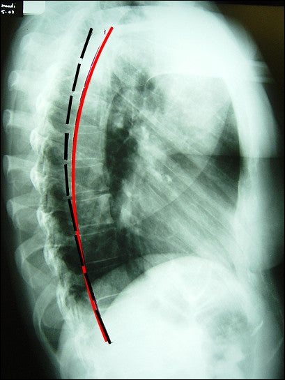 Thoracic Normal Template