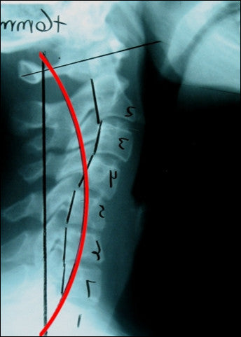 Cervical Normal Template
