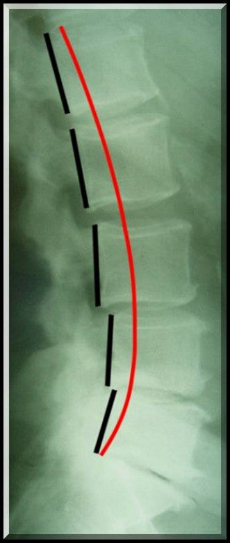 Lumbar Normal Template